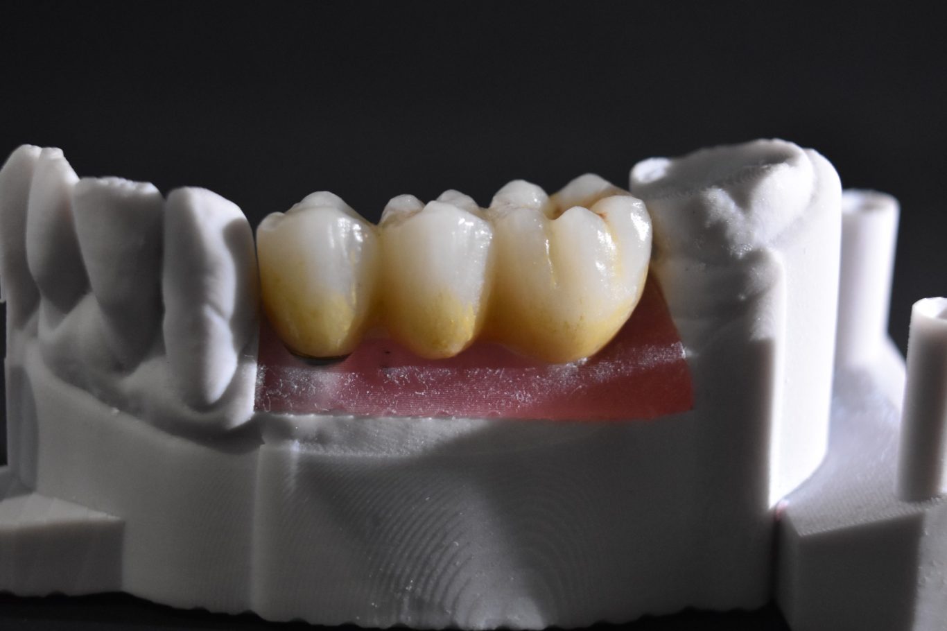 Zirconio-Cerámica 44-46 (vista vestibular)