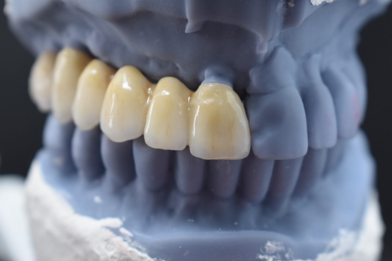 Zirconio-Cerámica 11-16