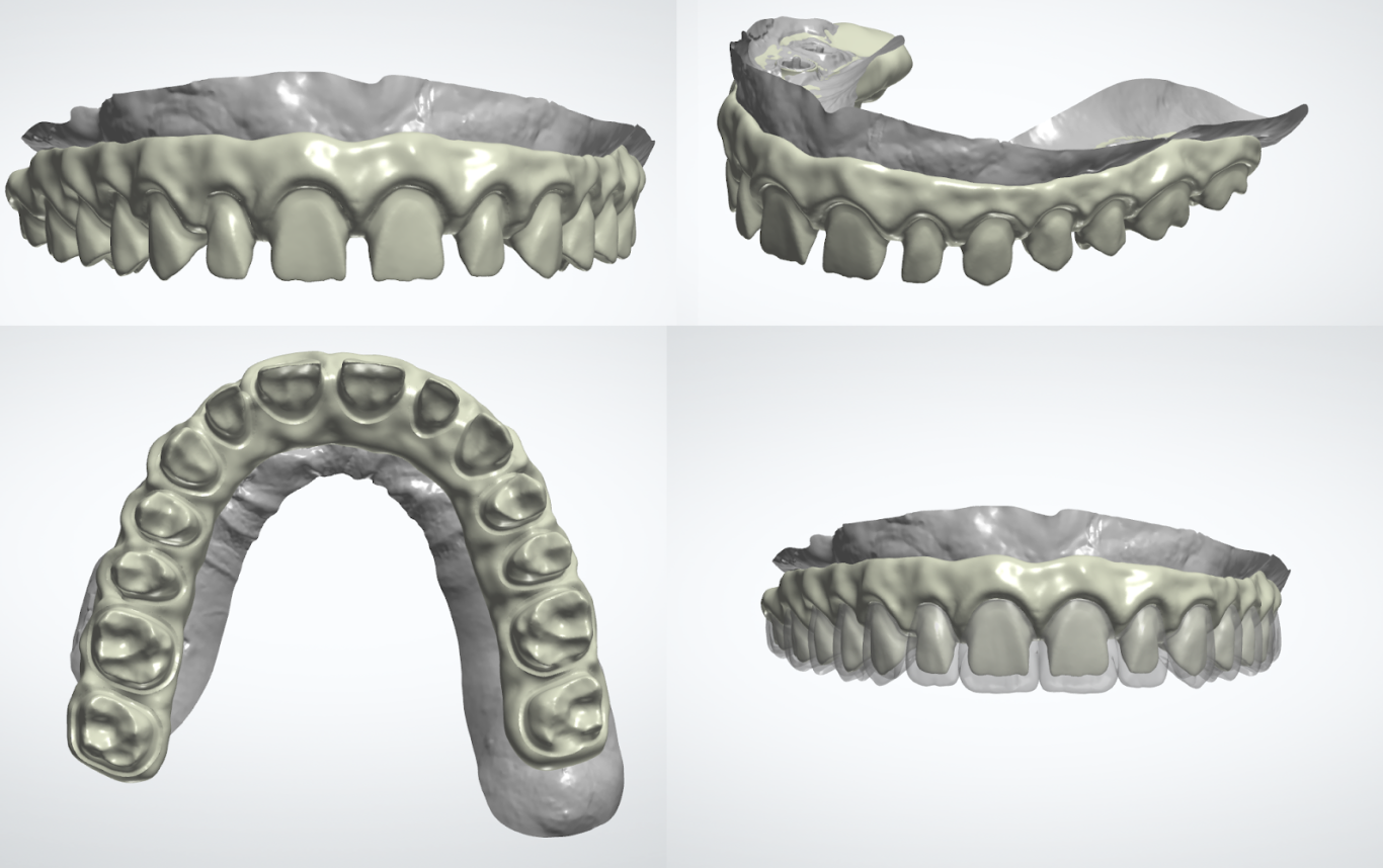 Estructura tipo Toronto (3Shape)