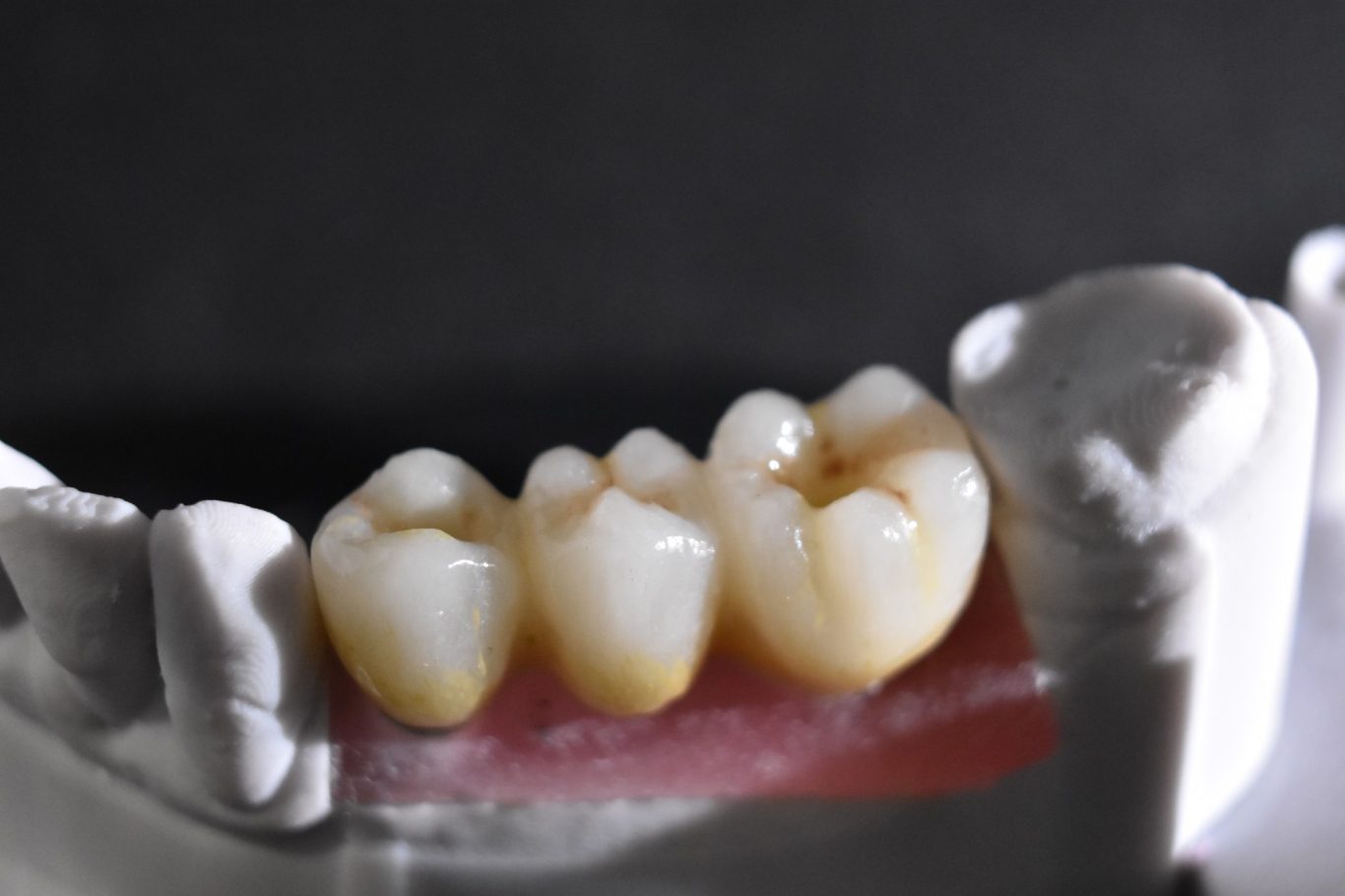 Zirconio-Cerámica 44-46 (vista oclusal)