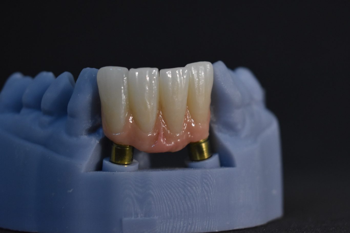 Zirconio monolítico 42-32, encía estratificada.