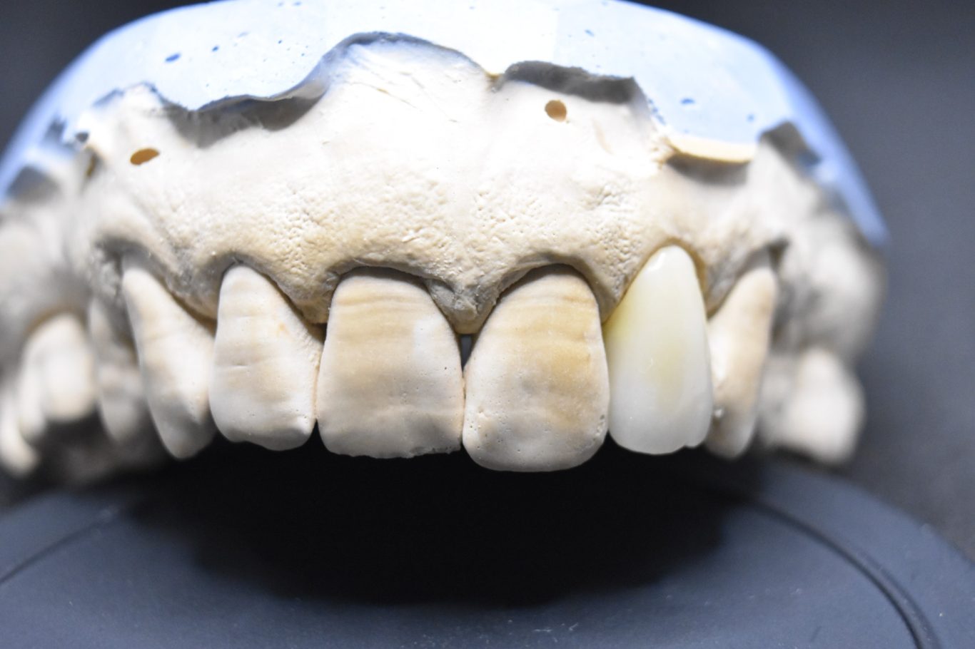 Zirconio-Cerámica 22