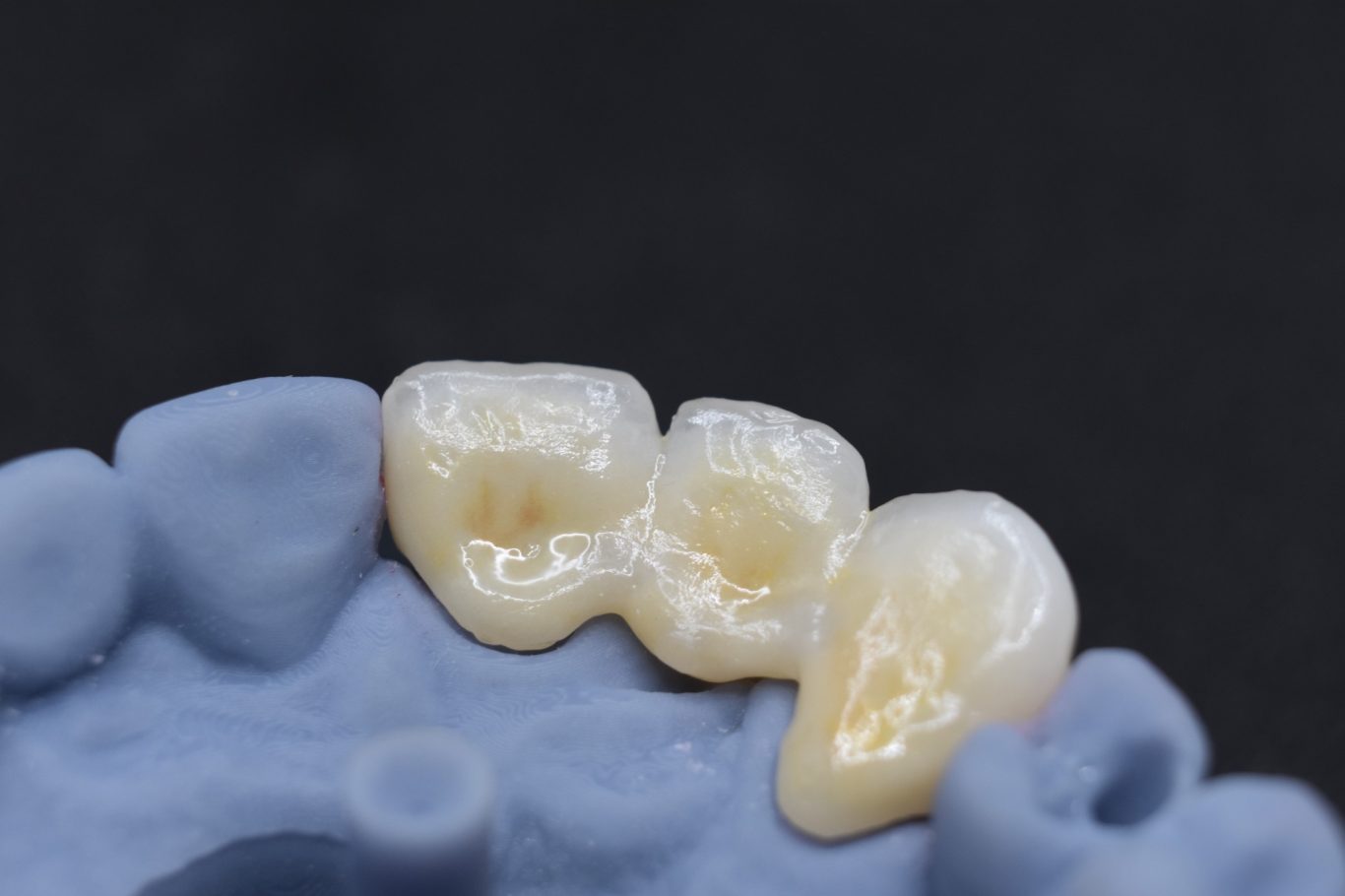 Zirconio-Cerámica 21-23 (vista palatino)