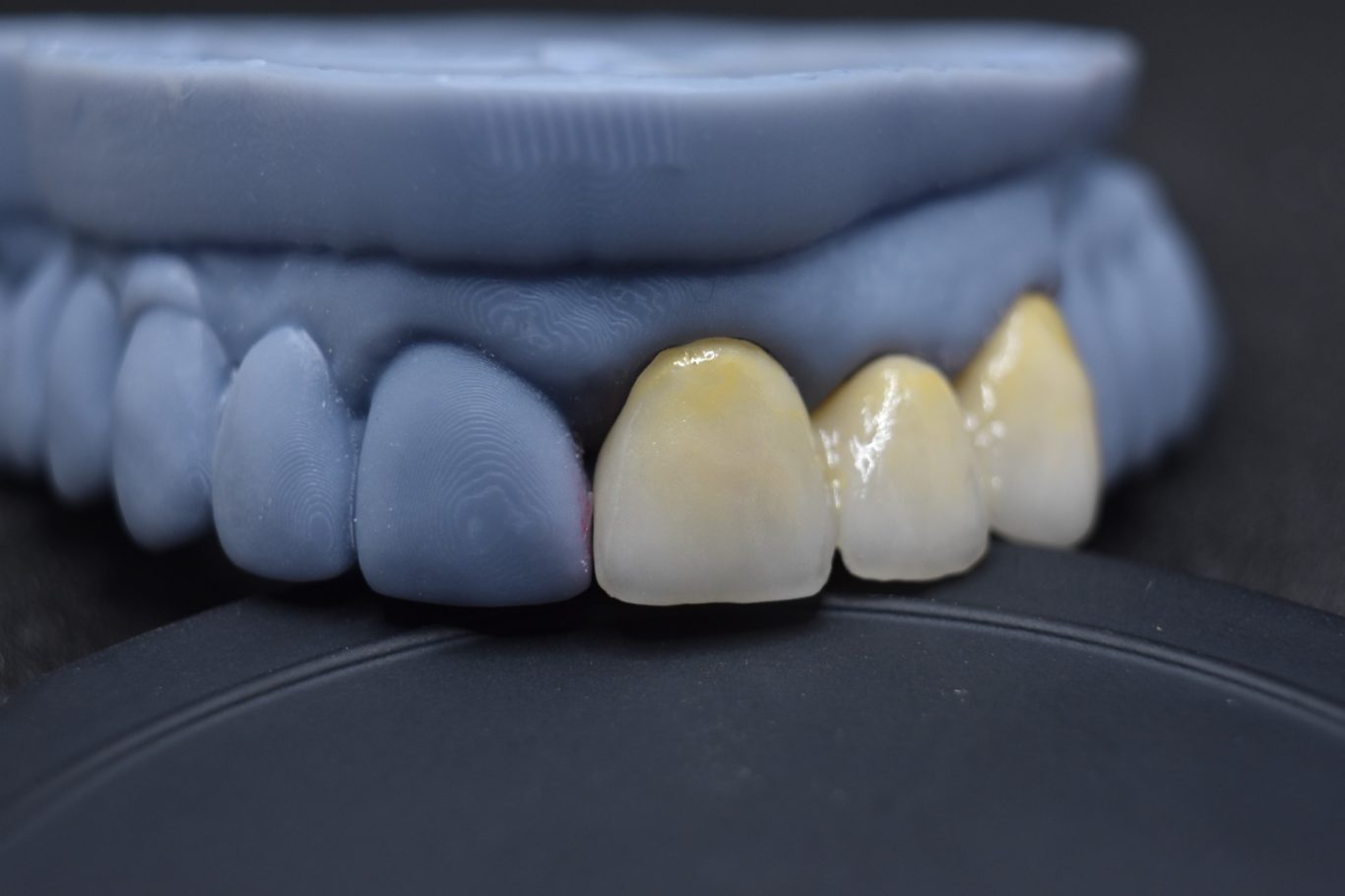 Zirconio-Cerámica 21-23 (vista vestibular)